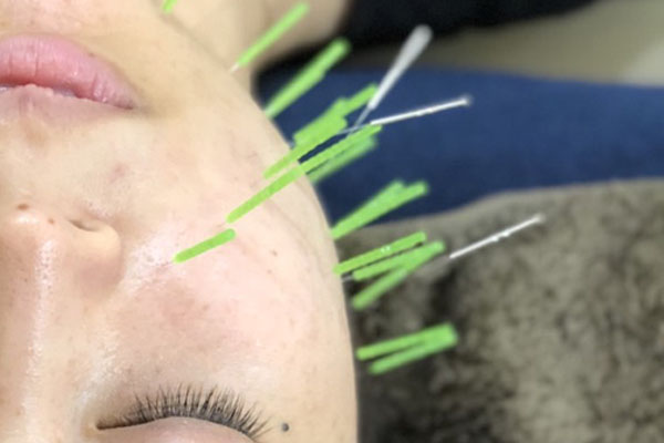 美容鍼
